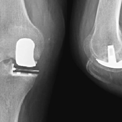 Prótesis unicompartimental