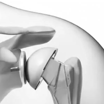 Plastia de Ligamento Cruzado Anterior Artroscópica