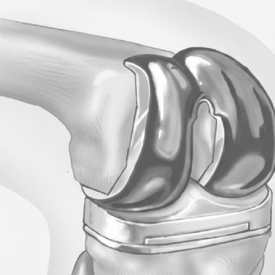 Reemplazo total de Rodilla